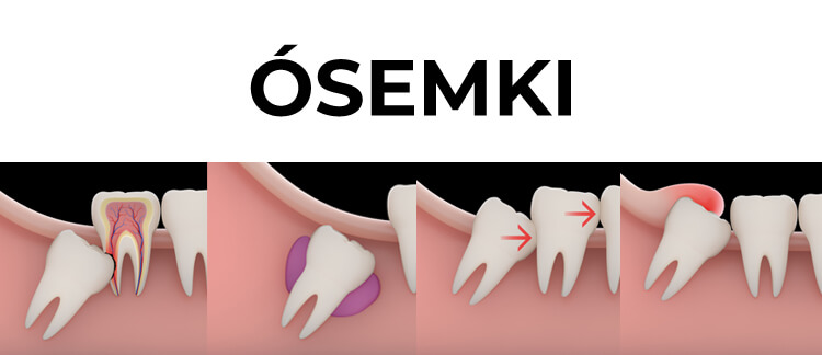 problemy z ósemkami