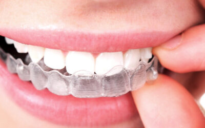 Invisalign – odmień swoje życie