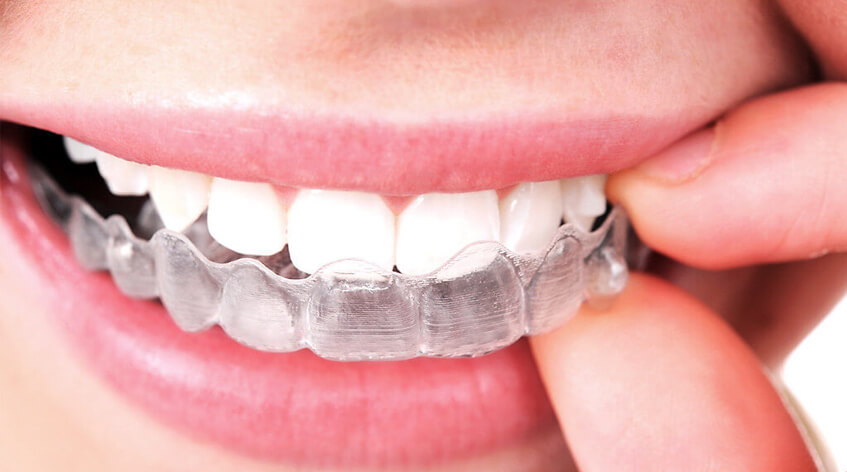 Invisalign – odmień swoje życie